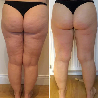 Anti-Cellulite Suction Cup